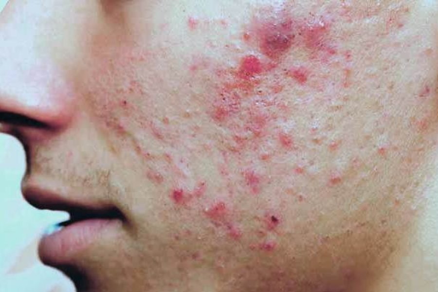 Acne story- A major goals for teenage