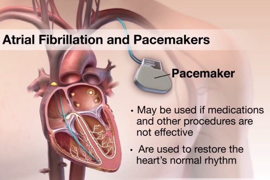 Atrial Fibrillation and Pacemakers