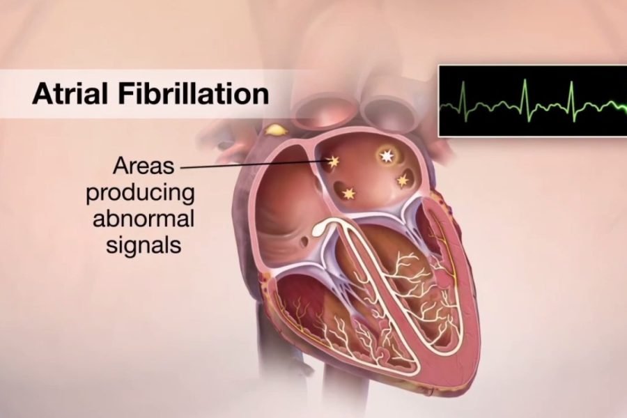 Atrial Fibrillation