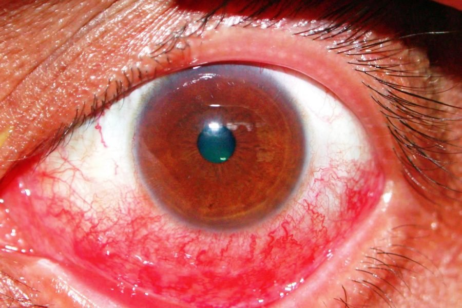 What is subconjunctival hemorrhage