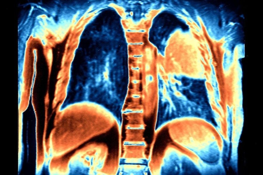 Lung Cancer Patients Live Longer With Immune Therapy