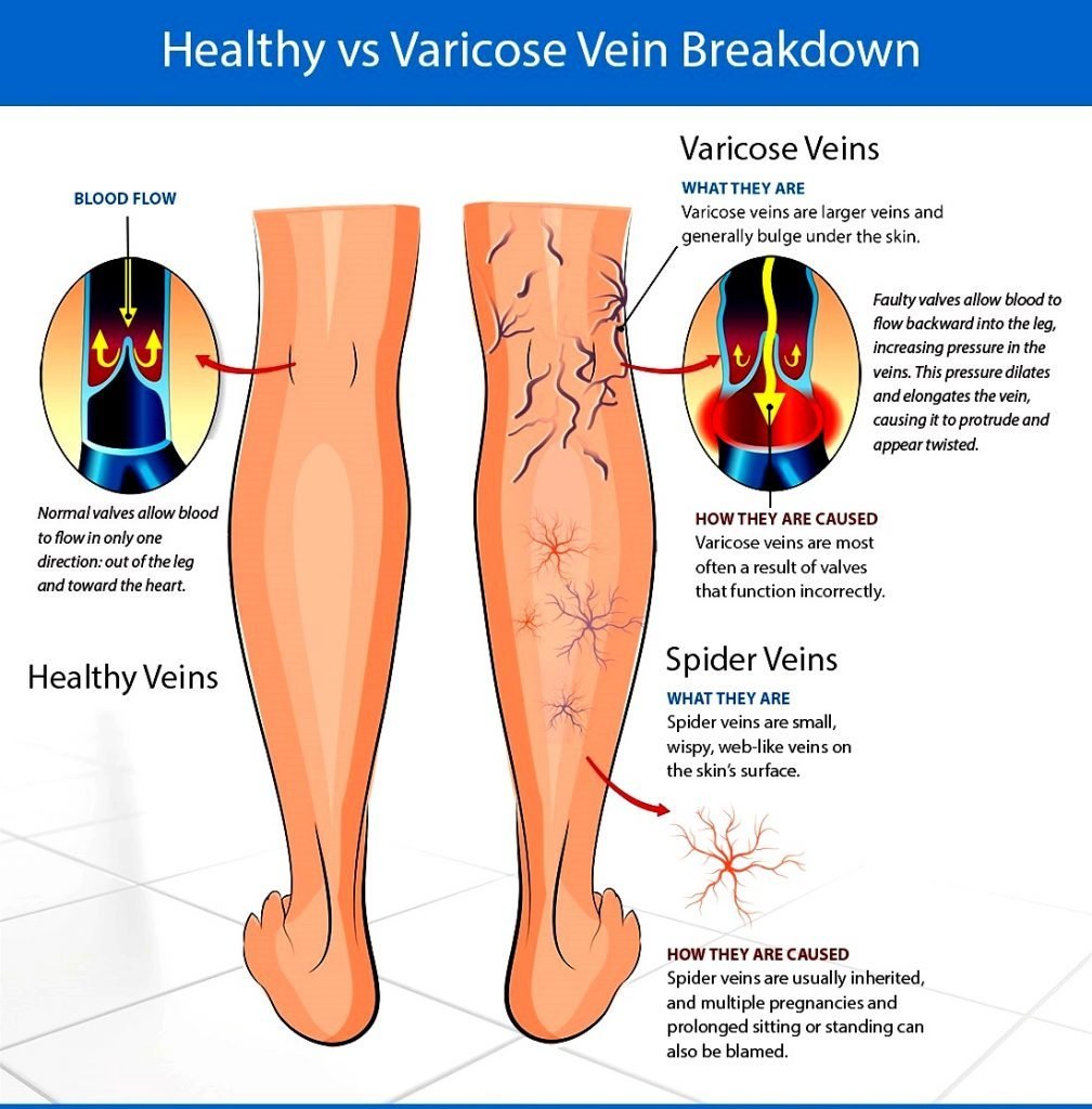 varicose-veins